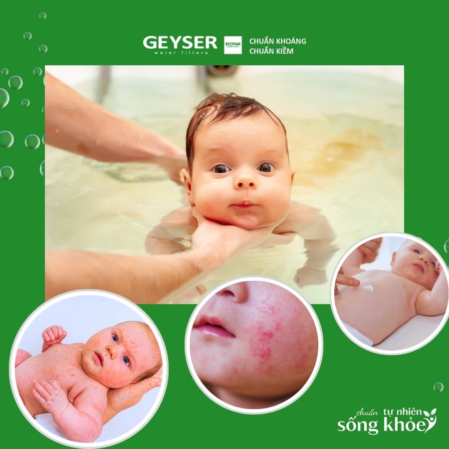 Nước tắm bẩn là nguyên nhân gây ra các bệnh viêm da, rôm sảy ở trẻ nhỏ